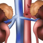 केएमसीले गरिब तथा असहाय तीन जना विरामीको निःशुल्क मिर्गौला प्रत्यारोपण गर्ने